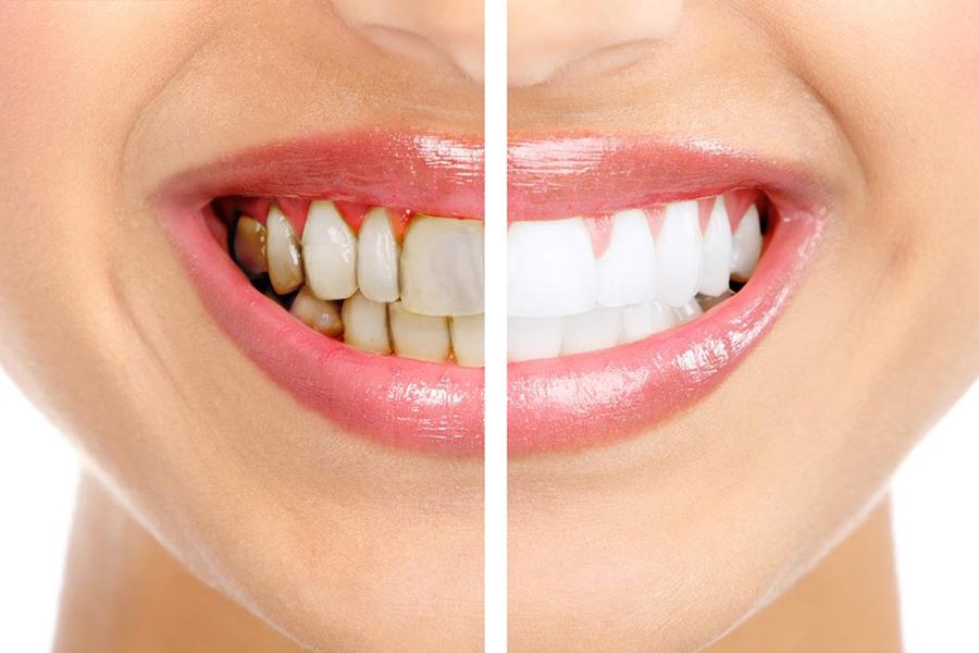 Composite Fillings