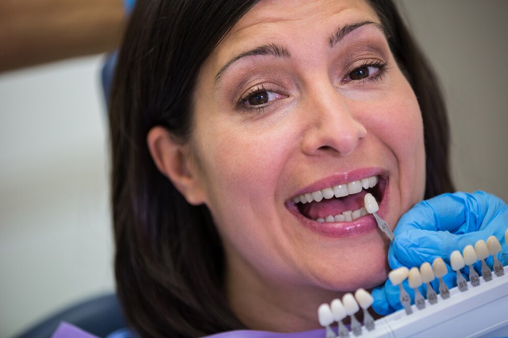 Veneers